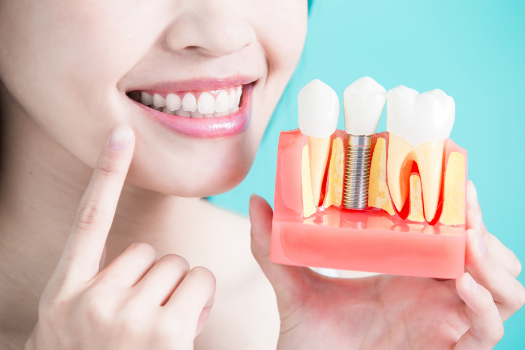 A woman showing a dental implant